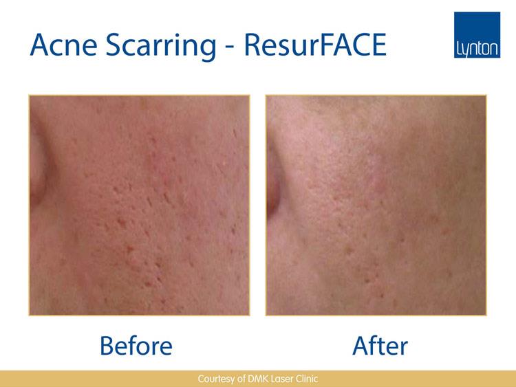 ResurFACE Acne Scarring
